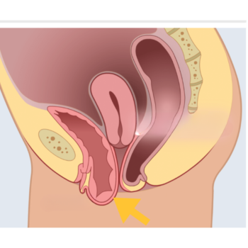 cistocele